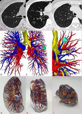 Application Research of Three-Dimensional Printing Technology and Three-Dimensional Computed Tomography in Segmentectomy